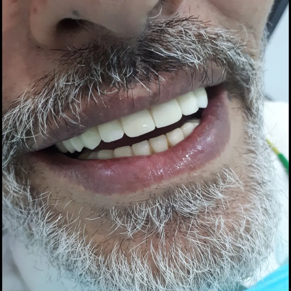 After: fixed full-arch implant bridge