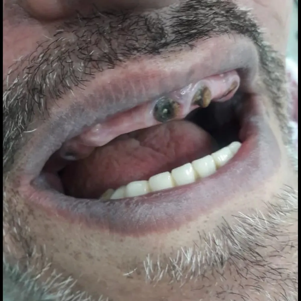 Before: full-arch tooth loss