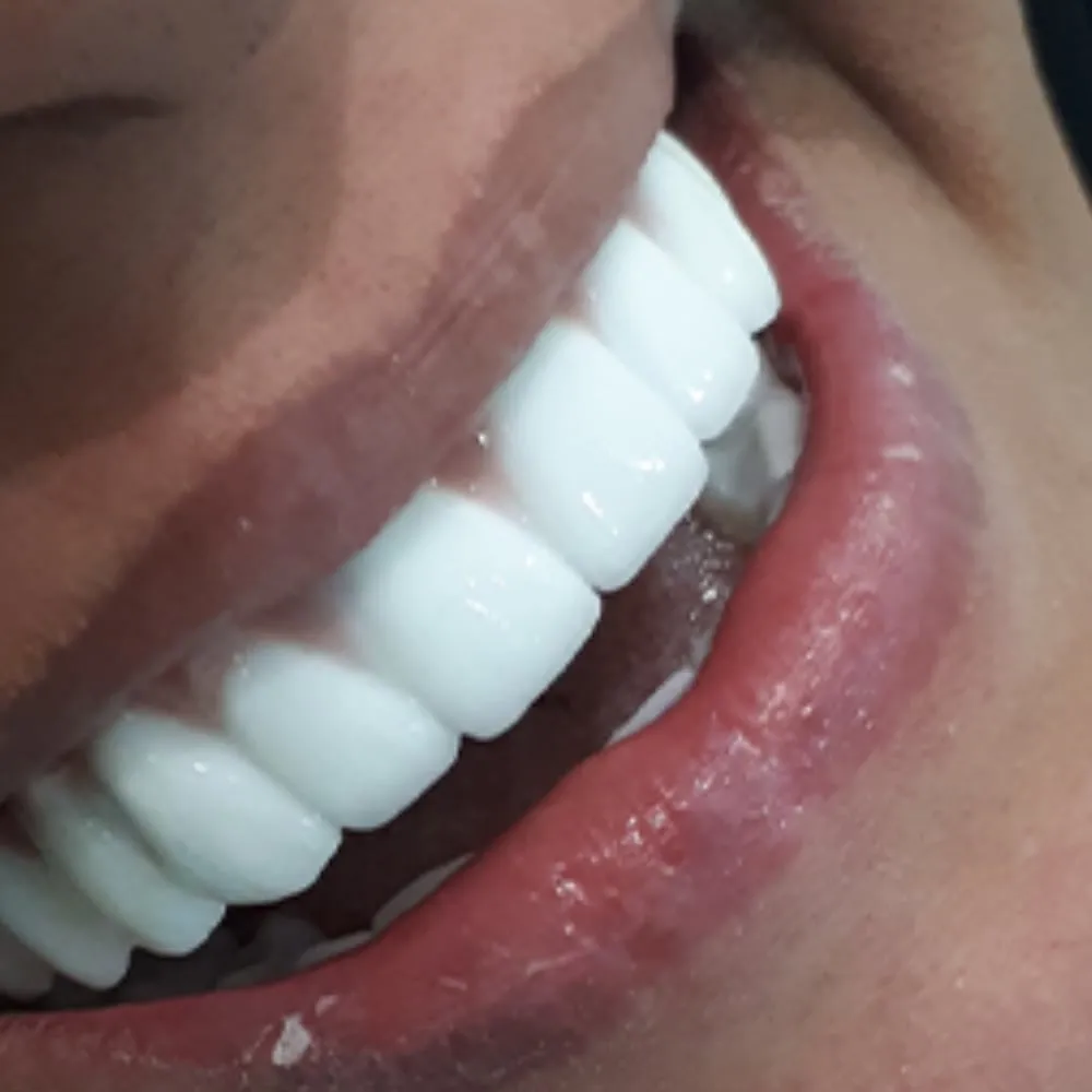 After: fixed full-arch restoration