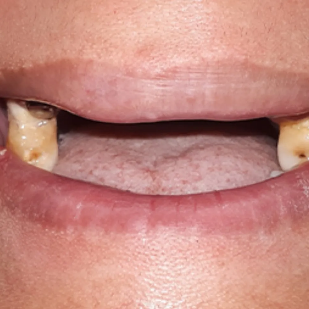 Before: severe tooth loss with only two remaining teeth